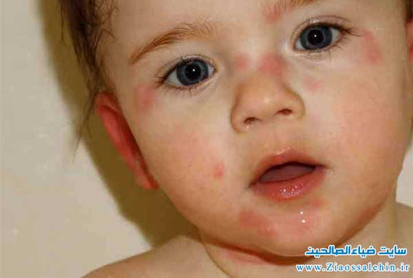 زمانی که علائم آلرژی غذای در کودک خود میبینید ، چه باید کنید؟