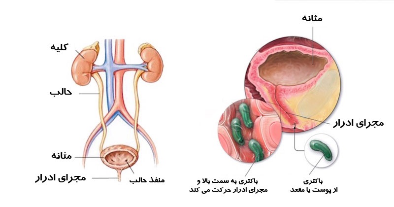 علل و درمان عفونت اداری مکرر در بانوان