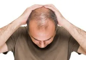 ریزش مو
