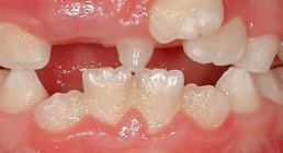 انواع دندان اضافه در کودکان