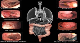 تشخیص سریع سرطان روده بزرگ با کولونوسکوپی